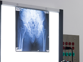 Reemplazo Articular