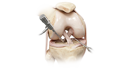  Artroscopía de Rodilla