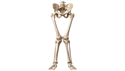 Alineación de Piernas (Osteotomías)