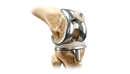Prótesis de Rodilla